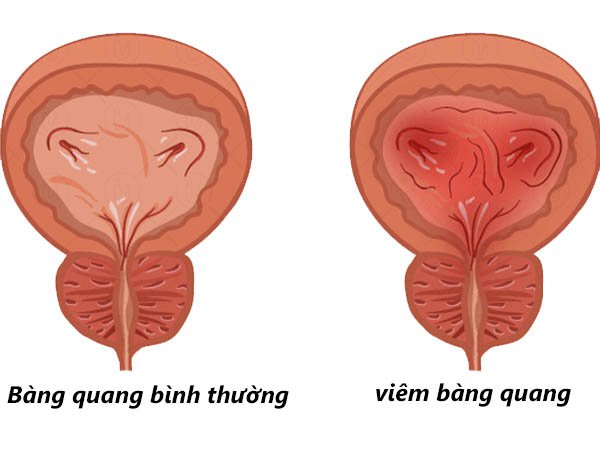 Viêm bàng quang cấp là nhiễm trùng bàng quang do vi khuẩn E.coli gây ra.